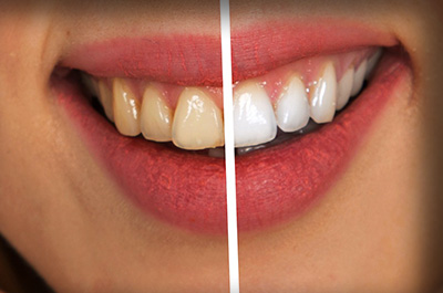 Igiene dentale e sbiancamento